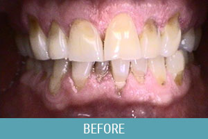 Before Dental Treatment 01