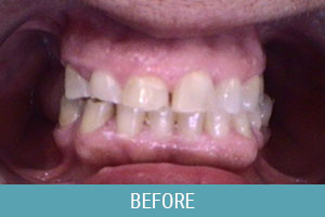 Before Dental Treatment 02