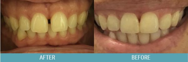 Teeth Gaps before after image 2