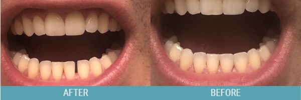Teeth gaps before after image 1