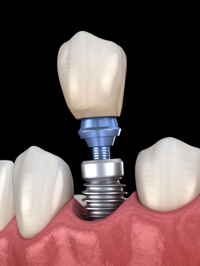 What is a Dental implant?